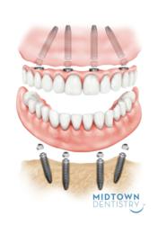 fixed bridge on dental implants